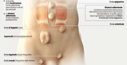 Ernie addominali: Ernie addominali: L'intestino che "esce" dalla sede